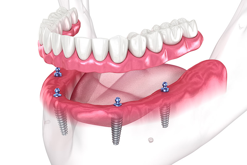 Full-Arch Implant Dentistry at Dr. Shelby Moutardier D.M.D.
