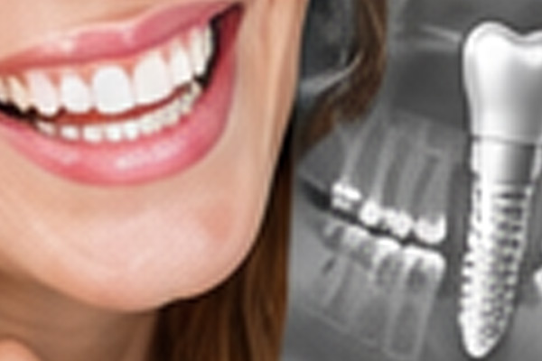Dental Implants at Dr. Shelby Moutardier D.M.D.